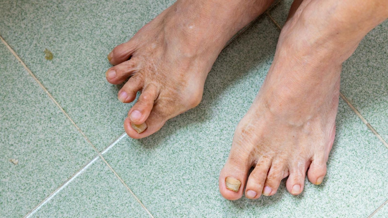 Hallux valgus : 15 remèdes de grand-mère pour le soulager naturellement